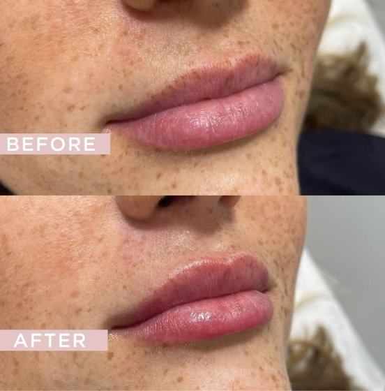 Russian Lips Before & After